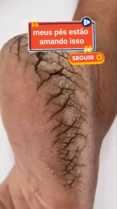 LIXADOR DE PÉ ELÉTRICO ESFOLIADOR DE CALOS E RACHADURAS NO PÉ #lixador #lixaeletrica #lixa #lixadepe #lixadeiraeletrica #lixadepe  #pe #perachado